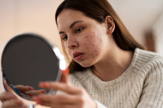 How to choose best pimple cream